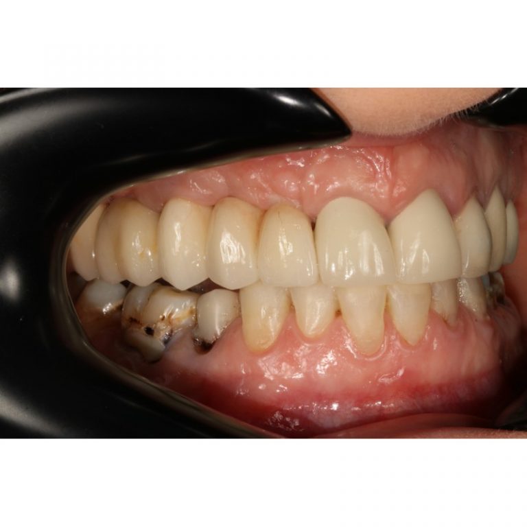 One Side CHEEK RETRACTOR Autoclavable Black Dental Market