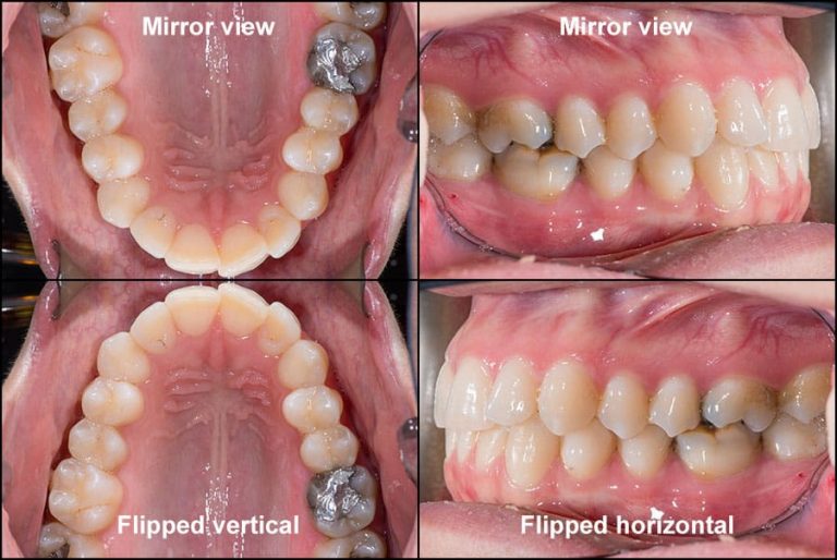 POP Clear Mirror Occlusal and Buccal Intraoral for Dental photography